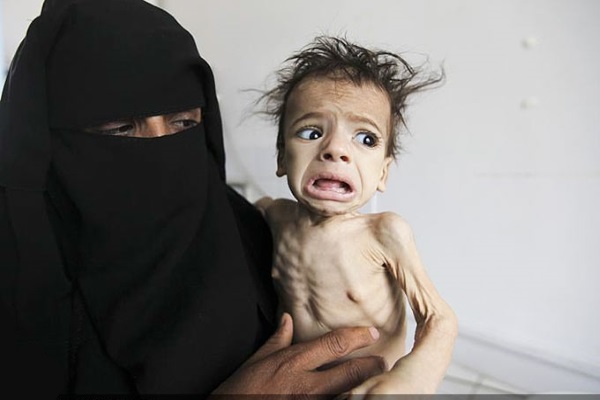 ملت یمن در مثلث مرگ! هر جنایتکاری، نمی تواند اینگونه کودکان یمن را به قتل برساند!!